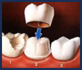 A typical molar crown